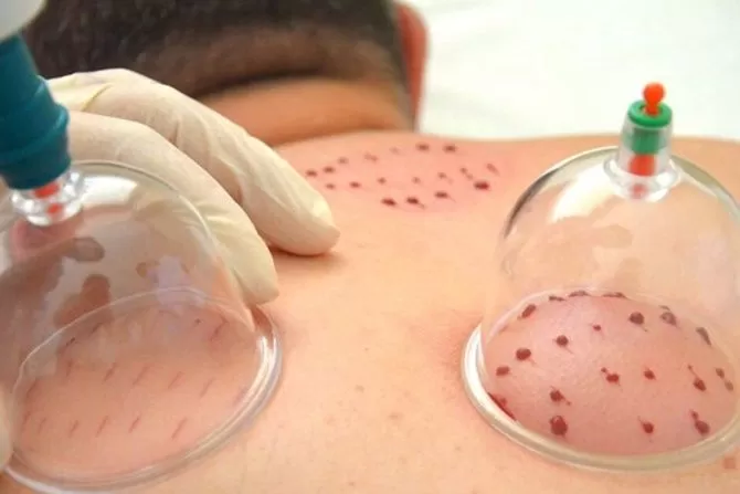 mengenal-seluk-beluk-teknik-bekam-dan-3-khasiatnya_m_-1